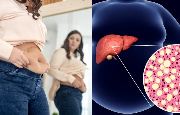This Fatty Liver Detox Helped Me Finally Lose Weight Without Counting a Single Calorie