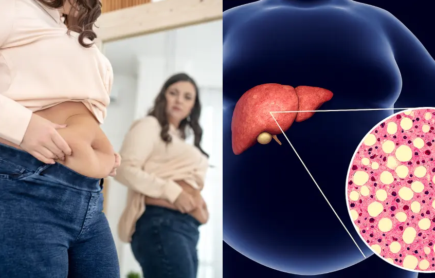 This Fatty Liver Detox Helped Me Finally Lose Weight Without Counting a Single Calorie